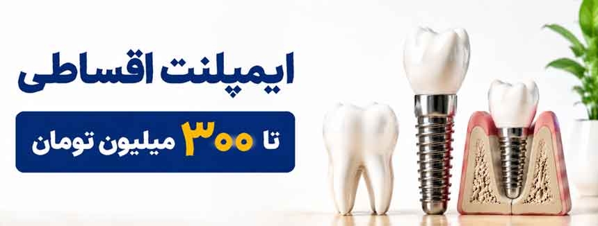 قبل از ایمپلنت اقساطی دندان چه نکاتی را باید بدانیم - راهنمای کامل قبل از کاشت دندان